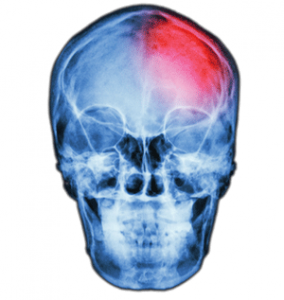 Brain inflammation shown in X-ray